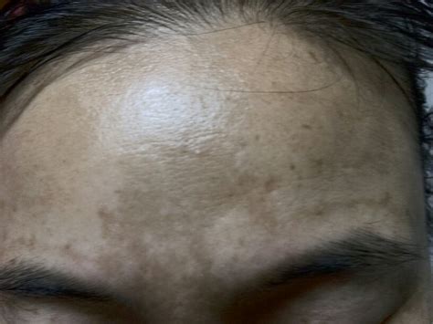 額頭黑斑|黑斑 (Melasma)